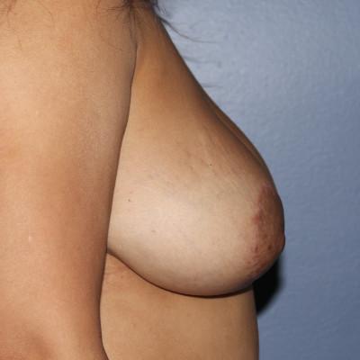 Samuel Lin, MD, FACS breast augmentation revision after — Boston, MA