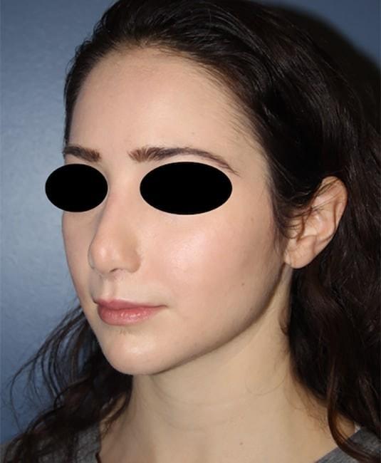 Rhinoplasty before at Samuel Lin, MD, FACS in Boston, MA