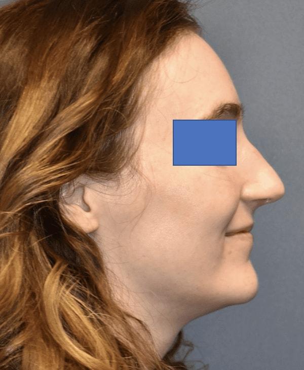 Rhinoplasty after at Samuel Lin, MD, FACS in Boston, MA