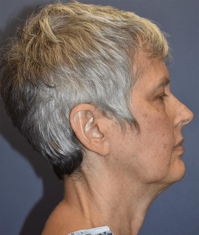 Deep Plane Facelift before at Samuel Lin, MD, FACS in Boston, MA