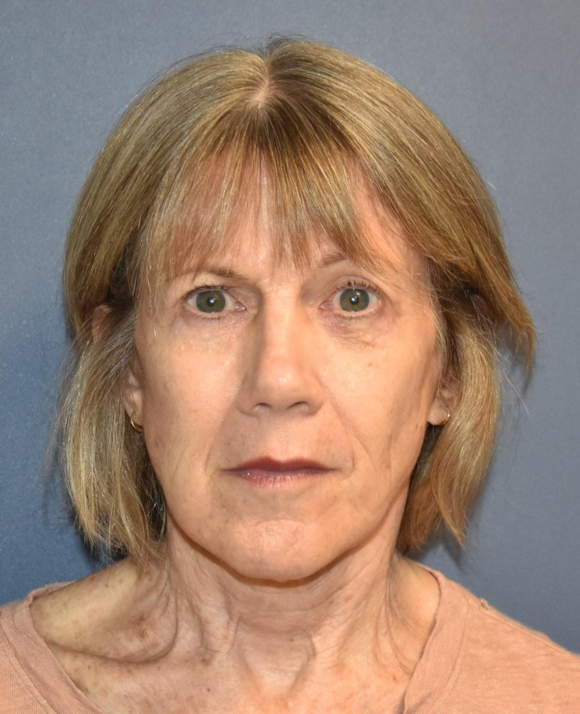 Samuel Lin, MD, FACS facelift after — Boston, MA