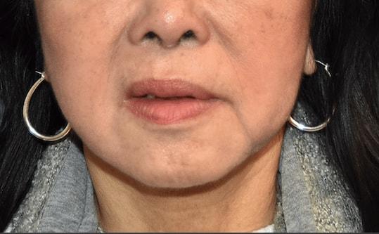 Neck Lift after at Samuel Lin, MD, FACS in Boston, MA