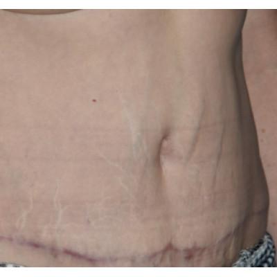 Tummy Tuck after at Samuel Lin, MD, FACS in Boston, MA