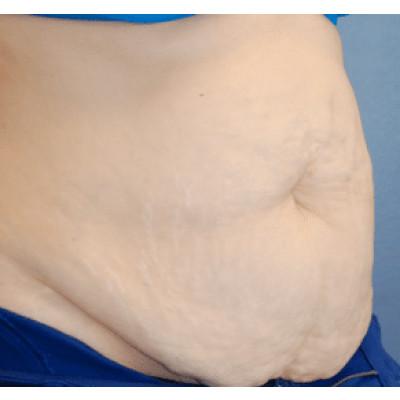 Tummy Tuck before at Samuel Lin, MD, FACS in Boston, MA