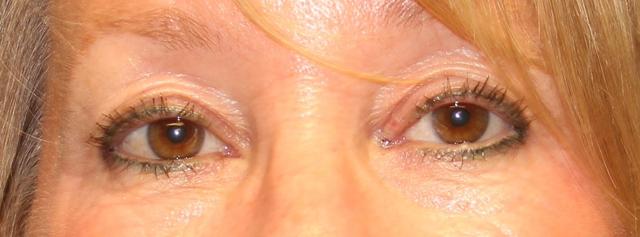 Blepharoplasty before at Samuel Lin, MD, FACS in Boston, MA