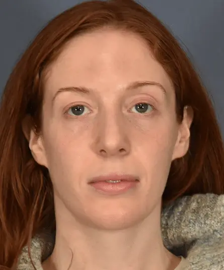 Rhinoplasty after at Samuel Lin, MD, FACS in Boston, MA