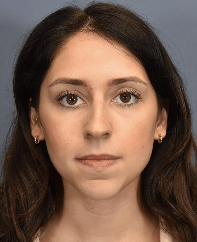 Rhinoplasty before at Samuel Lin, MD, FACS in Boston, MA