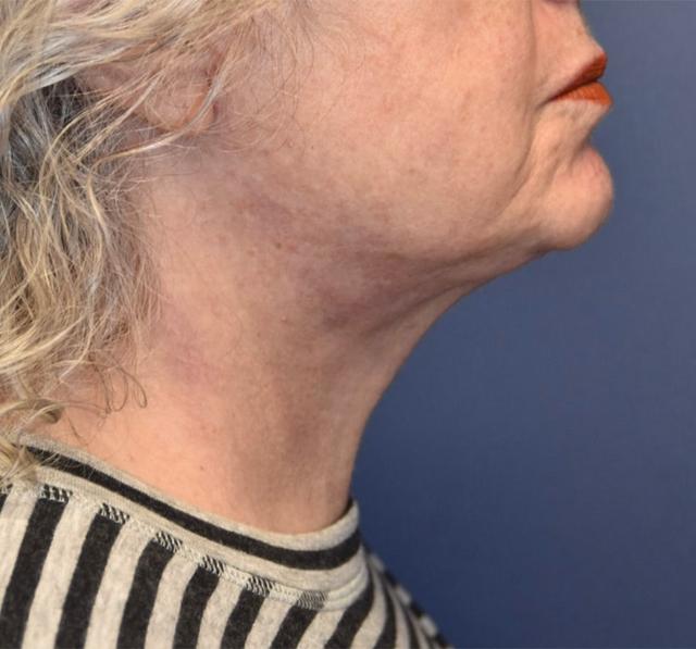 Neck Lift after at Samuel Lin, MD, FACS in Boston, MA