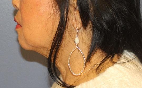 Neck Lift before at Samuel Lin, MD, FACS in Boston, MA