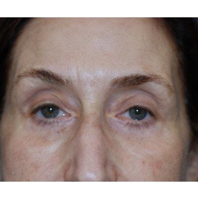 Samuel Lin, MD, FACS eyelid lift after — Boston, MA