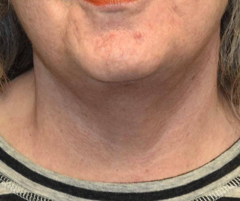 Samuel Lin, MD, FACS neck lift after — Boston, MA