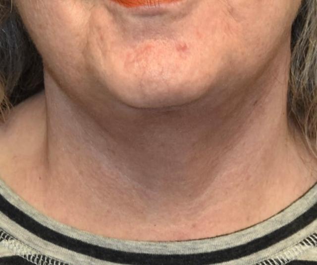 Neck Lift after at Samuel Lin, MD, FACS in Boston, MA