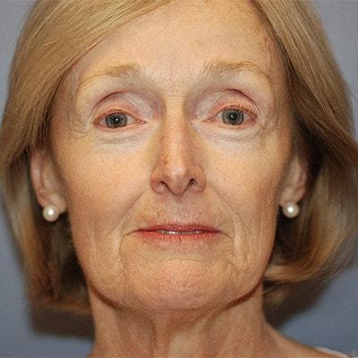 Deep Plane Facelift before at Samuel Lin, MD, FACS in Boston, MA