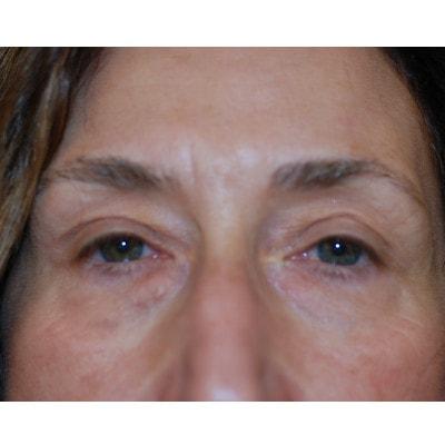 Blepharoplasty before at Samuel Lin, MD, FACS in Boston, MA