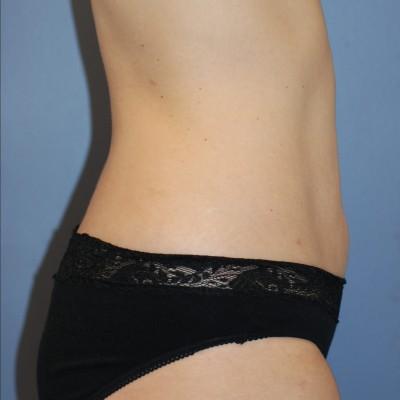 Liposuction after at Samuel Lin, MD, FACS in Boston, MA