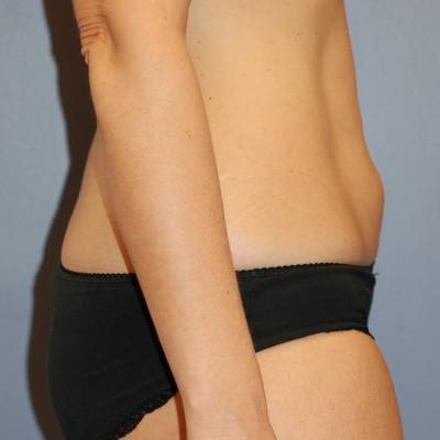 Liposuction before at Samuel Lin, MD, FACS in Boston, MA