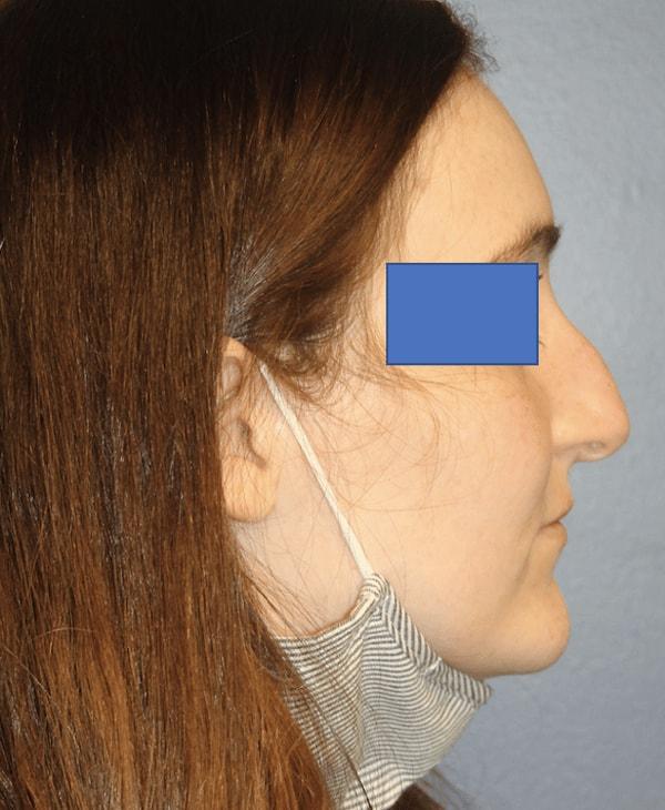 Rhinoplasty before at Samuel Lin, MD, FACS in Boston, MA