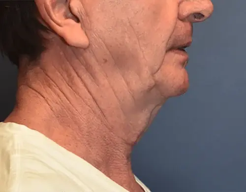 Neck Lift before at Samuel Lin, MD, FACS in Boston, MA