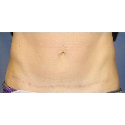 Tummy Tuck after at Samuel Lin, MD, FACS in Boston, MA