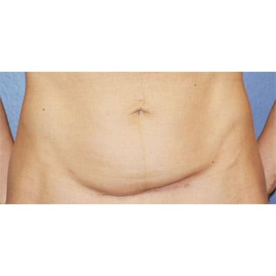 Tummy Tuck before at Samuel Lin, MD, FACS in Boston, MA