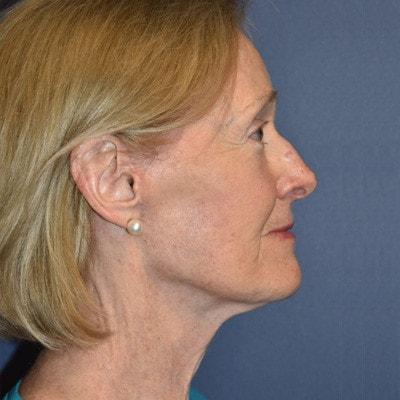 Deep Plane Facelift after at Samuel Lin, MD, FACS in Boston, MA