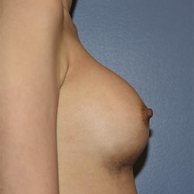 Breast Augmentation after at Samuel Lin, MD, FACS in Boston, MA
