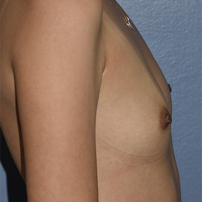 Breast Augmentation before at Samuel Lin, MD, FACS in Boston, MA
