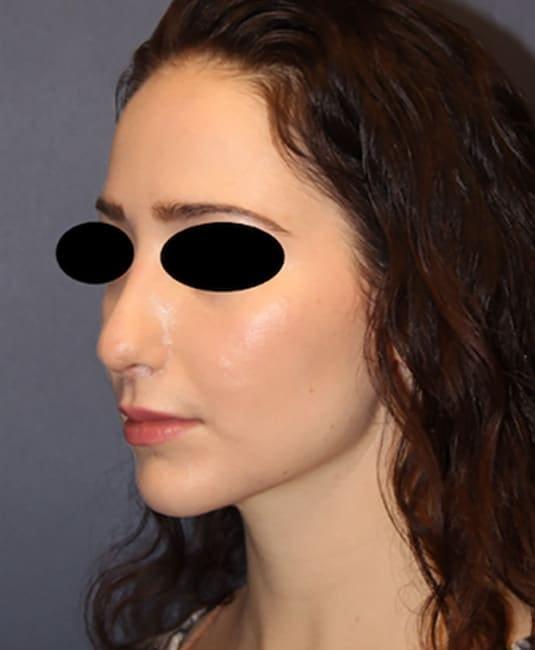 Rhinoplasty after at Samuel Lin, MD, FACS in Boston, MA
