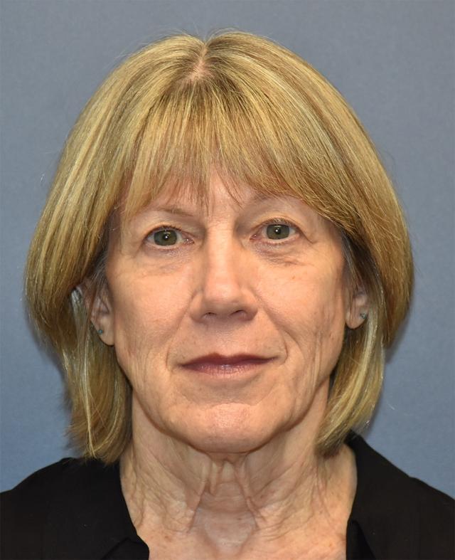 Deep Plane Facelift before at Samuel Lin, MD, FACS in Boston, MA