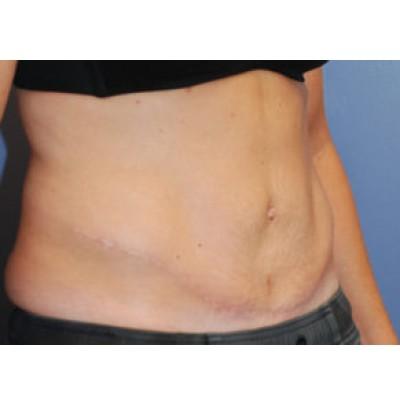 Tummy Tuck after at Samuel Lin, MD, FACS in Boston, MA