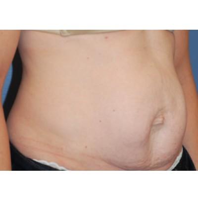 Tummy Tuck before at Samuel Lin, MD, FACS in Boston, MA