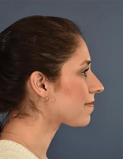 Rhinoplasty after at Samuel Lin, MD, FACS in Boston, MA