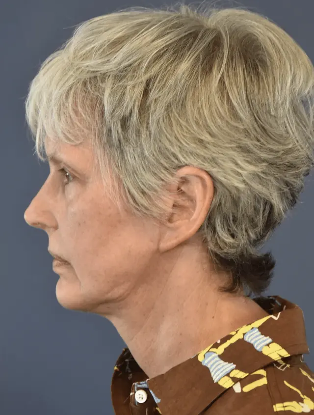 Deep Plane Facelift after at Samuel Lin, MD, FACS in Boston, MA