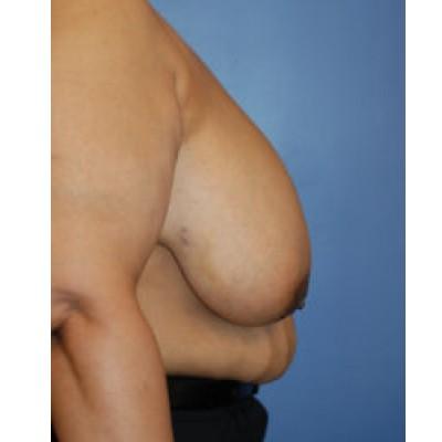 Breast Reduction before at Samuel Lin, MD, FACS in Boston, MA