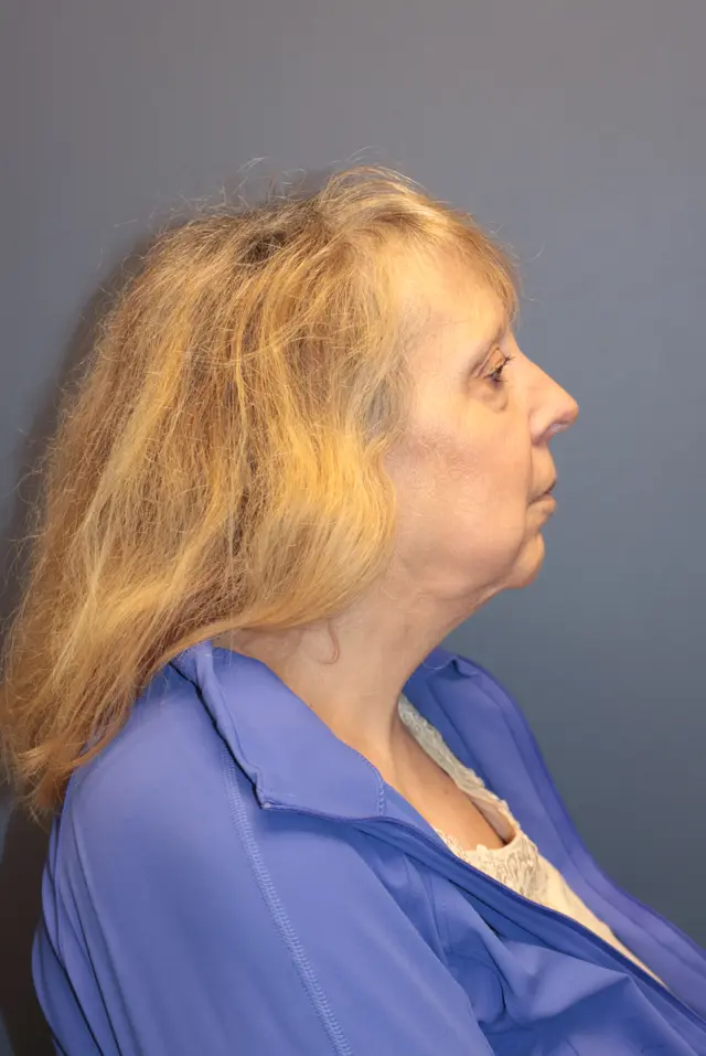 Deep Plane Facelift before at Samuel Lin, MD, FACS in Boston, MA