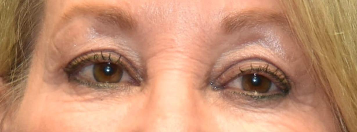 Samuel Lin, MD, FACS eyelid lift after — Boston, MA