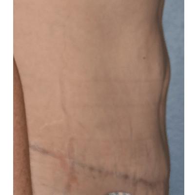 Tummy Tuck after at Samuel Lin, MD, FACS in Boston, MA
