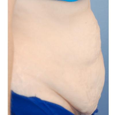 Tummy Tuck before at Samuel Lin, MD, FACS in Boston, MA