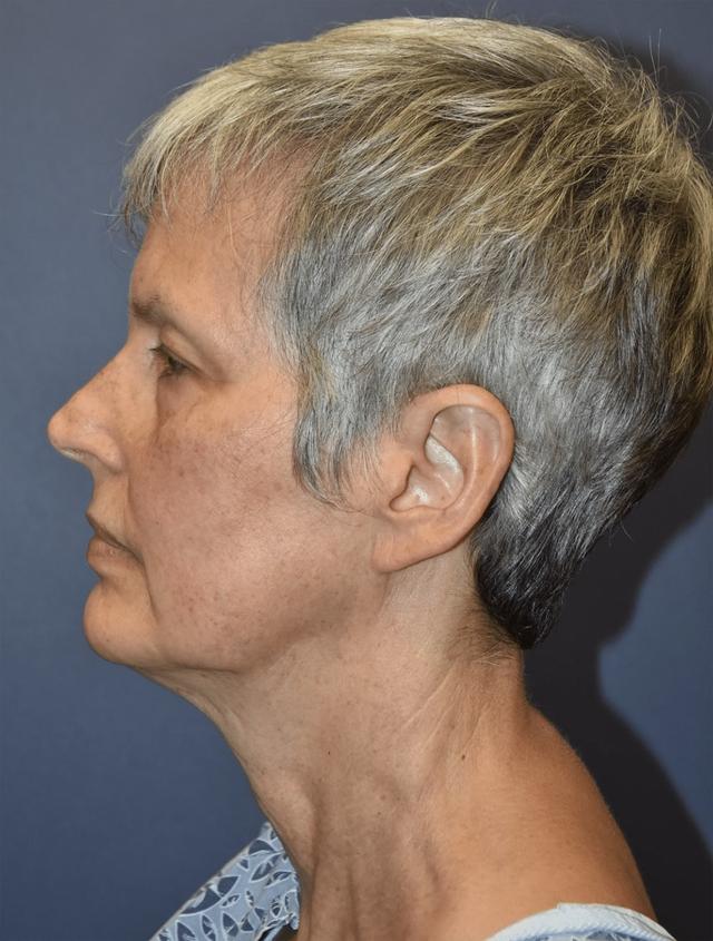Deep Plane Facelift before at Samuel Lin, MD, FACS in Boston, MA