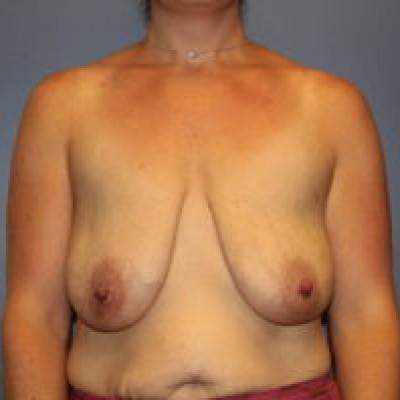 Breast Reduction before at Samuel Lin, MD, FACS in Boston, MA