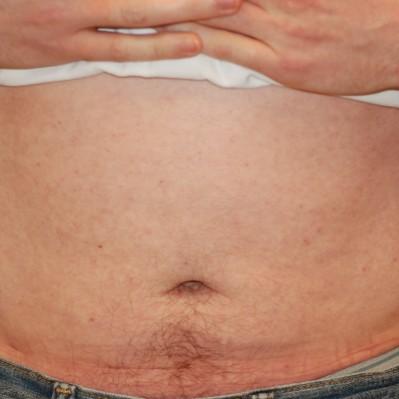 Liposuction after at Samuel Lin, MD, FACS in Boston, MA