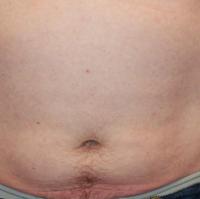 Liposuction before at Samuel Lin, MD, FACS in Boston, MA