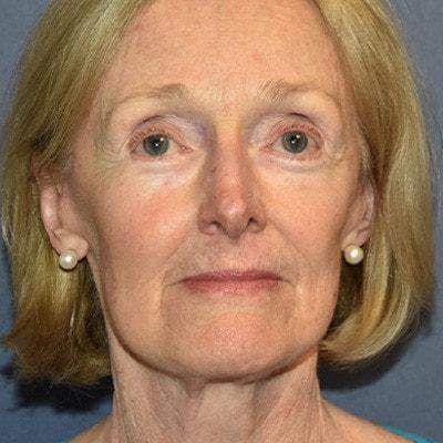 Deep Plane Facelift after at Samuel Lin, MD, FACS in Boston, MA
