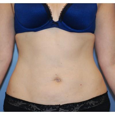 Samuel Lin, MD, FACS liposuction after — Boston, MA