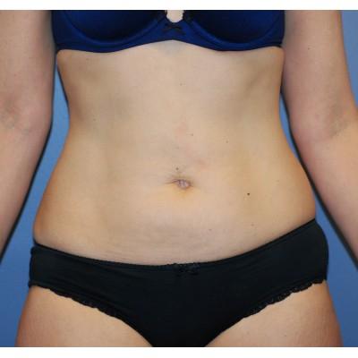Liposuction before at Samuel Lin, MD, FACS in Boston, MA
