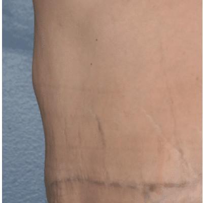 Tummy Tuck after at Samuel Lin, MD, FACS in Boston, MA