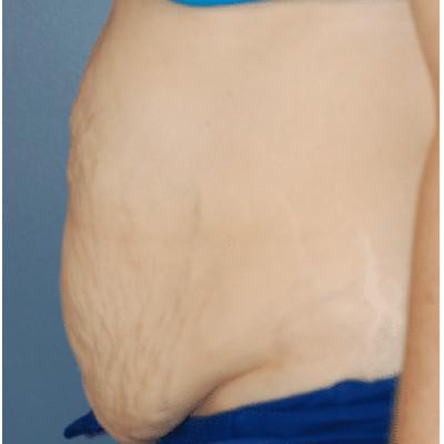 Tummy Tuck before at Samuel Lin, MD, FACS in Boston, MA