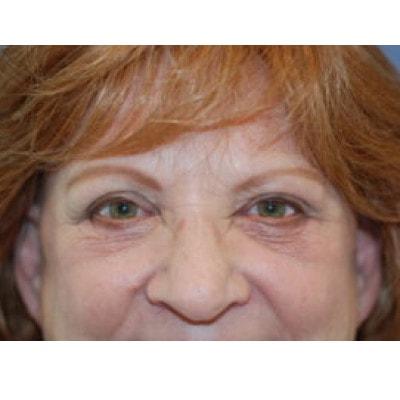 Samuel Lin, MD, FACS eyelid lift after — Boston, MA