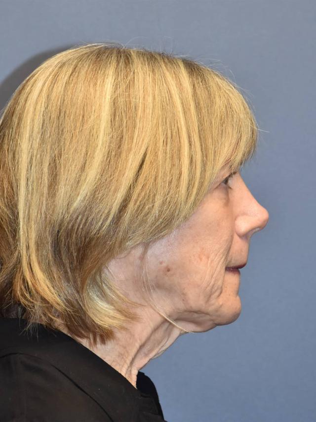 Deep Plane Facelift before at Samuel Lin, MD, FACS in Boston, MA