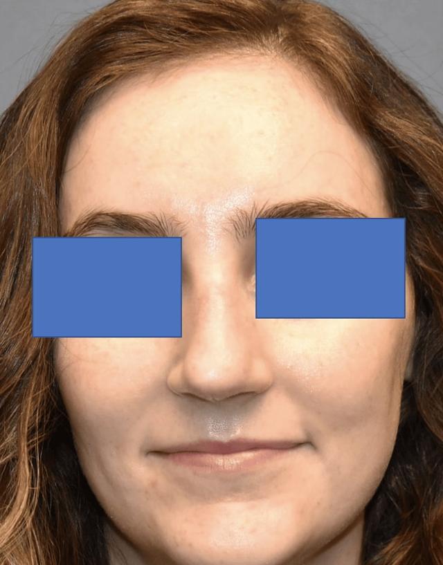 Rhinoplasty after at Samuel Lin, MD, FACS in Boston, MA